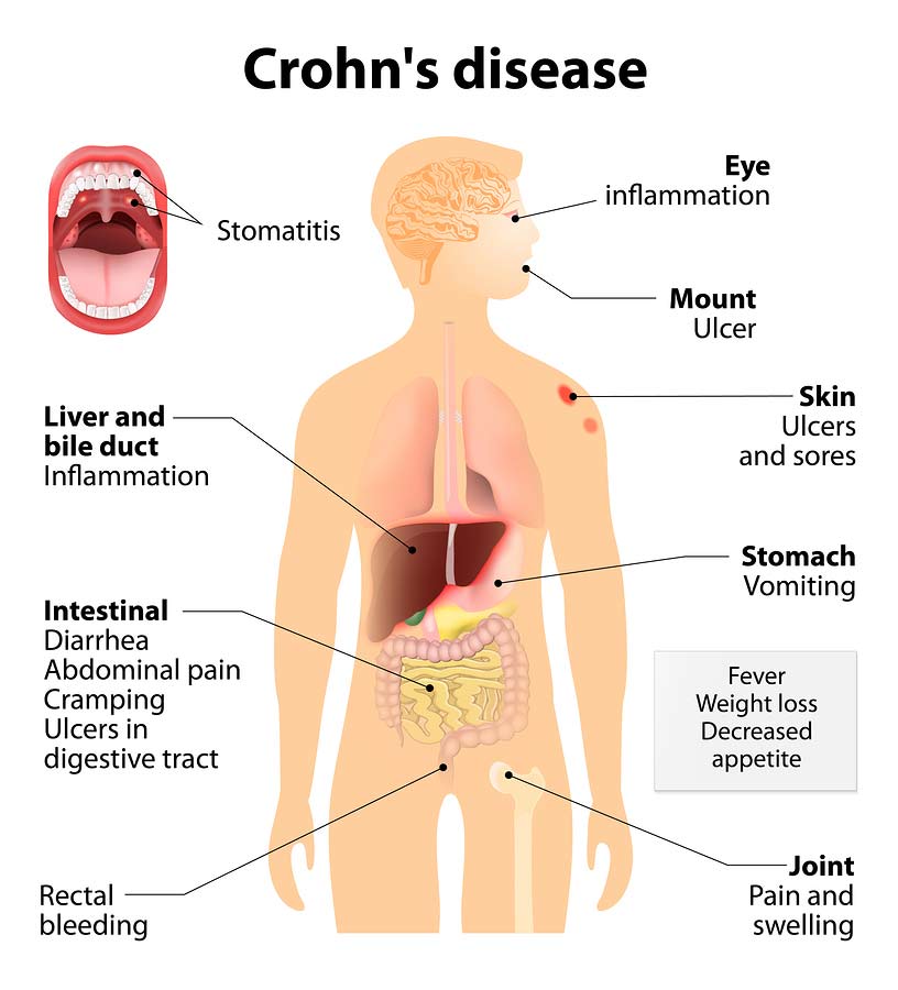 Symptoms of Crohn's Disease