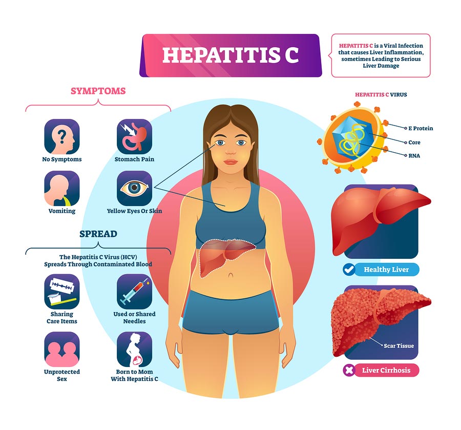 Hepatitis C symptoms and how it is spread