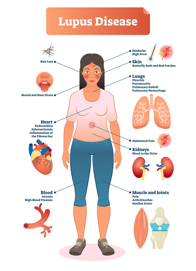 A diagram of Lupus symptoms